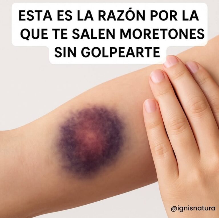 Esta es la razón por la que te salen moretones sin golpearte