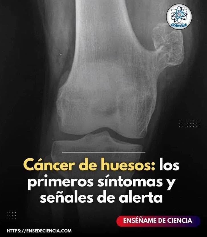 Síntomas iniciales del cáncer óseo: cómo reconocer las primeras señales