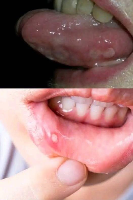 Aftas Bucales: Causas Comunes