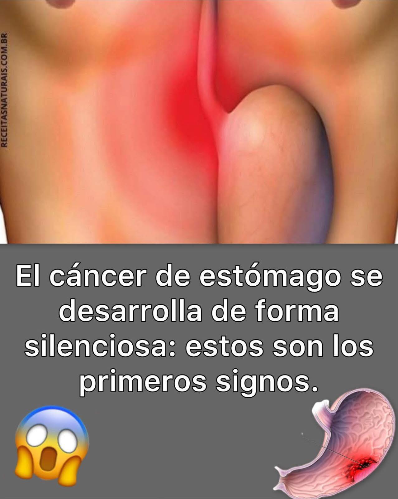 El cáncer de estómago: señales de alarma, causas, diagnóstico