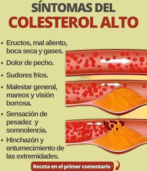  Estos Son los Síntomas del Colesterol Alto que No Sabías