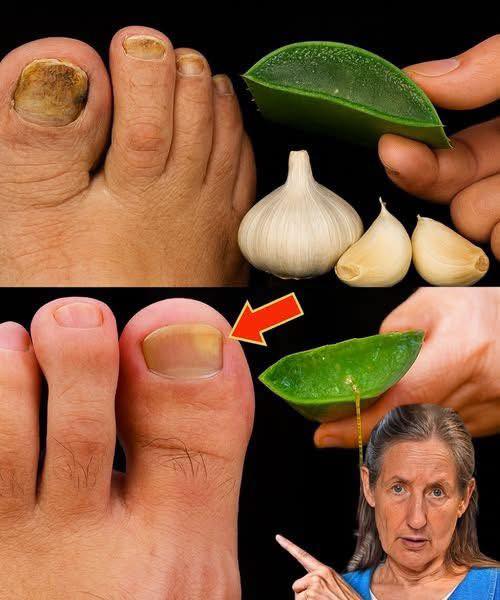 Remedio casero para el hongo de las uñas usando ajo y aloe vera