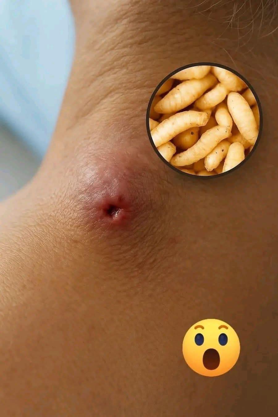 Pensó que era acné… pero lo que hallaron dentro te dejará sin palabras