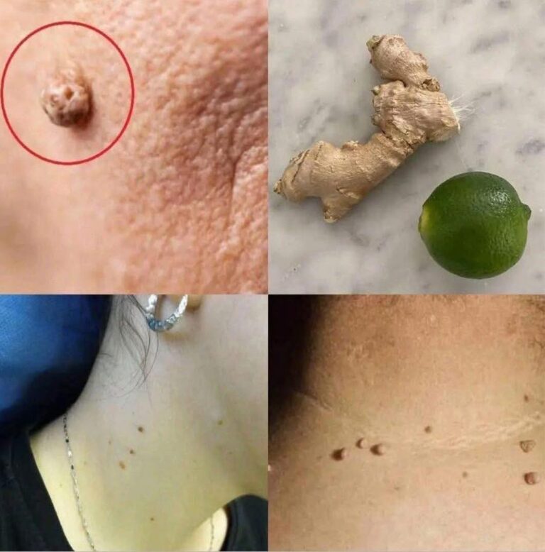 Las Verrugas Caen Como Hojas Con Tan Solo Aplicar Este Tratamiento Casero