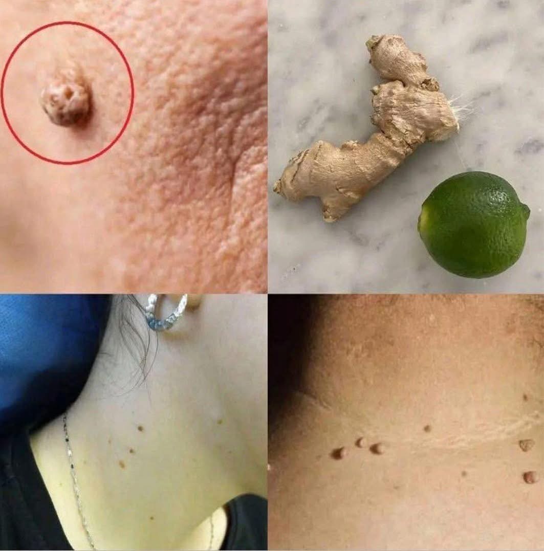 Las Verrugas Caen Como Hojas Con Tan Solo Aplicar Este Tratamiento Casero