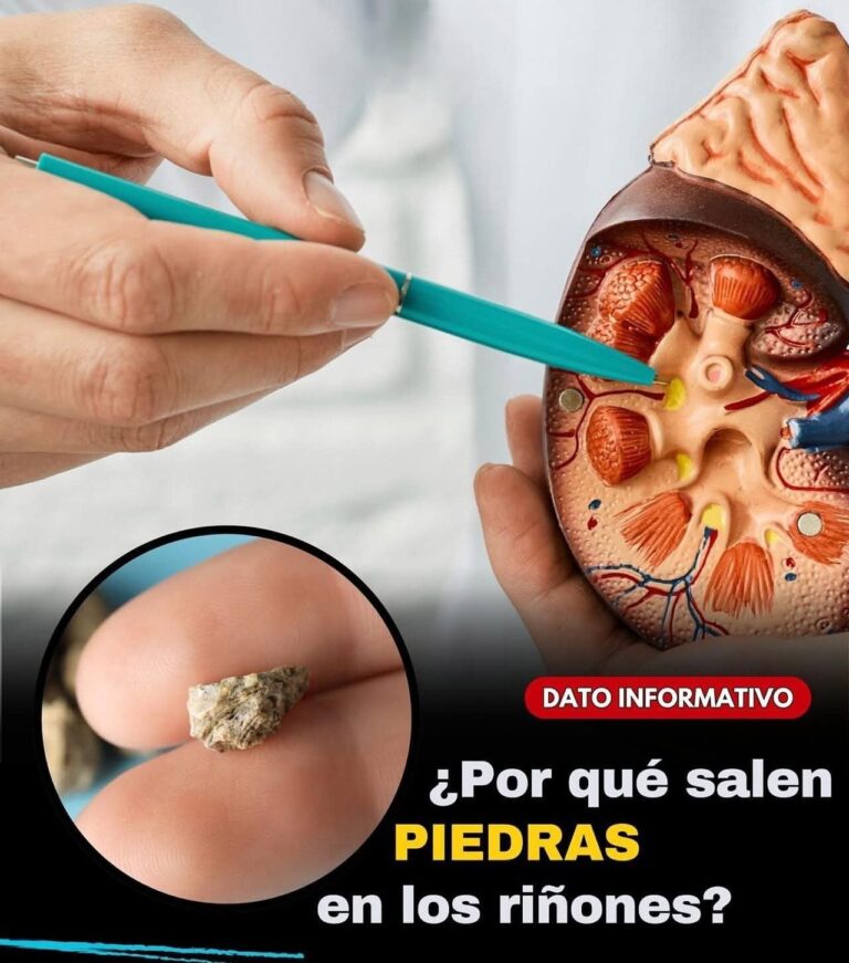 ¿Por qué salen piedras en los riñones? Remedios caseros para eliminarlas