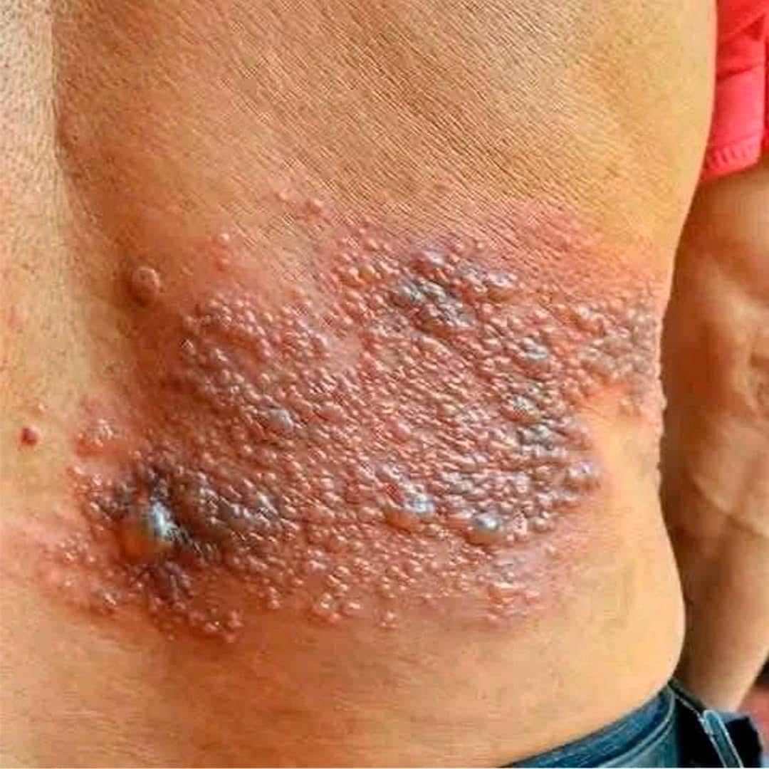 Picazón en el Cuerpo: Cuando una Presunta Alergia Puede Ser un Diagnóstico Serio