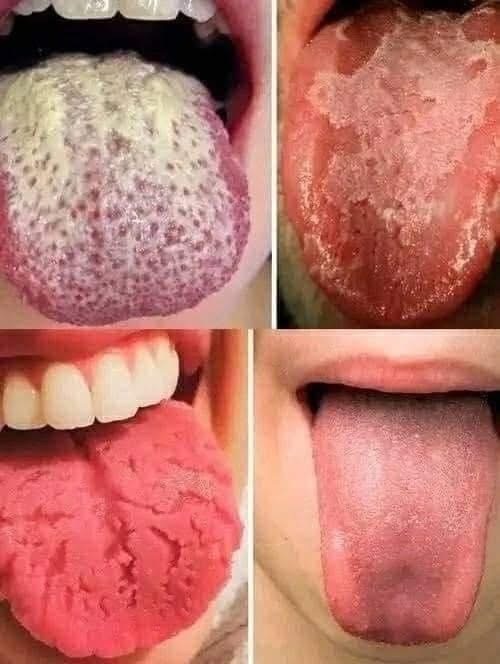 Lengua Blanca y Señales que Revelan tu Salud Bucal