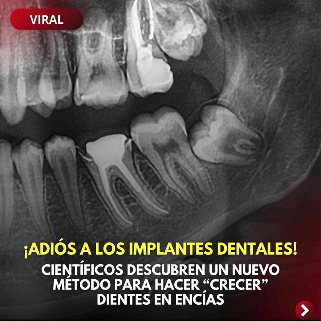 Revolucionario Método para el Crecimiento Dental: Una Alternativa a los Implantes Dentales