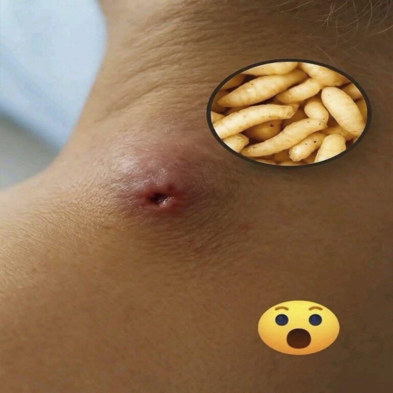 Pensó que era acné, pero resultó ser huevos de larvas