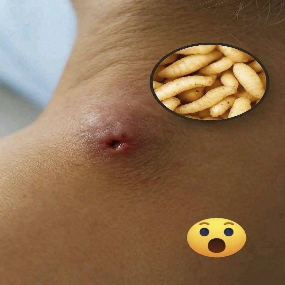 Pensó que era acné, pero resultó ser huevos de larvas