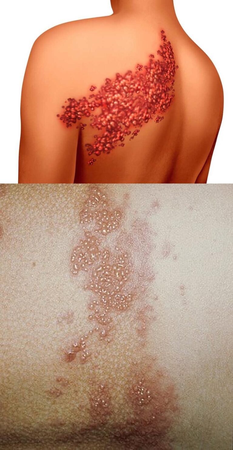 5 síntomas de la enfermedad culebrilla que debes saber