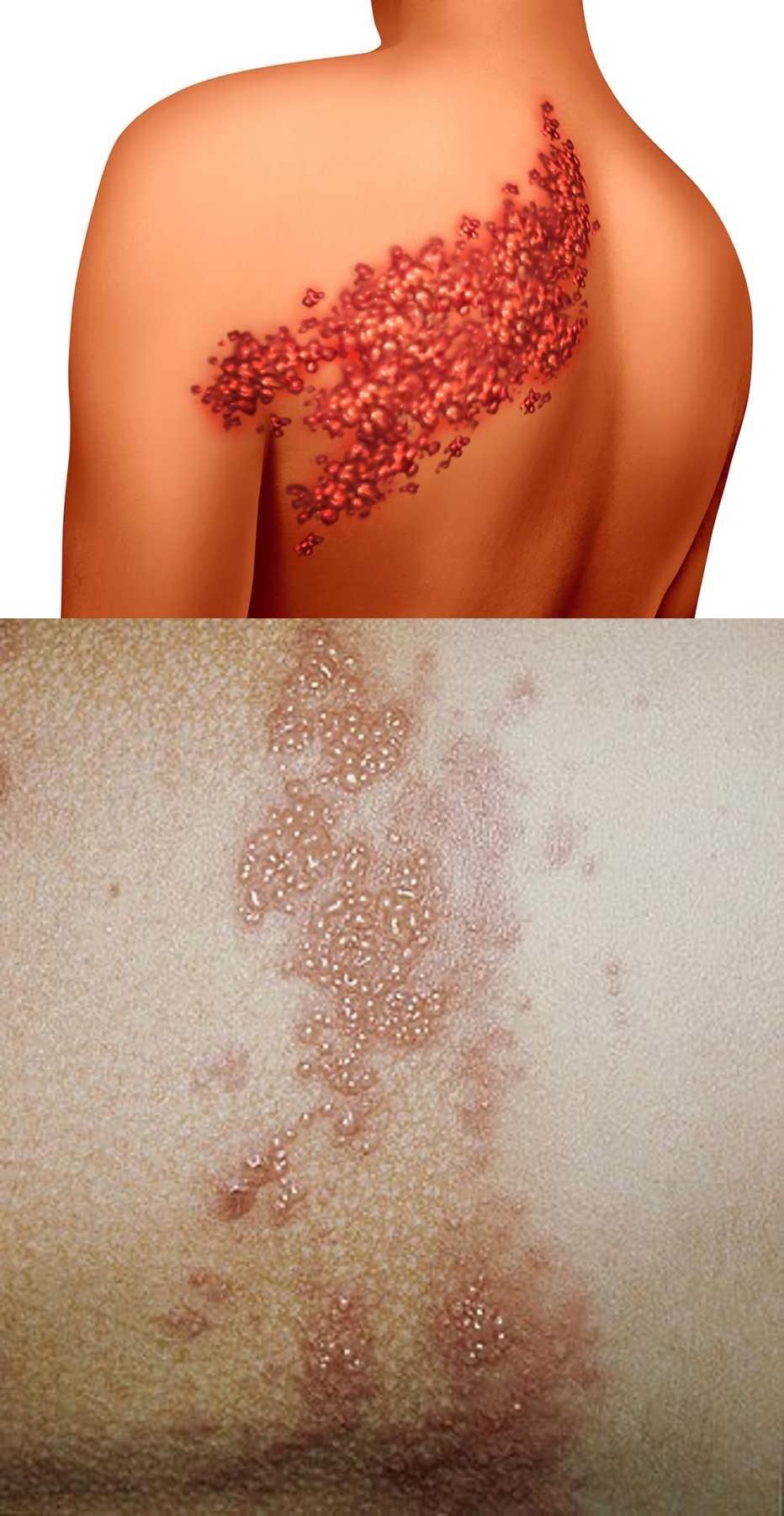 5 síntomas de la enfermedad culebrilla que debes saber