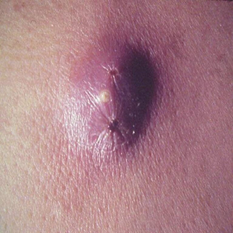 Tengan cuidado con el furuculos