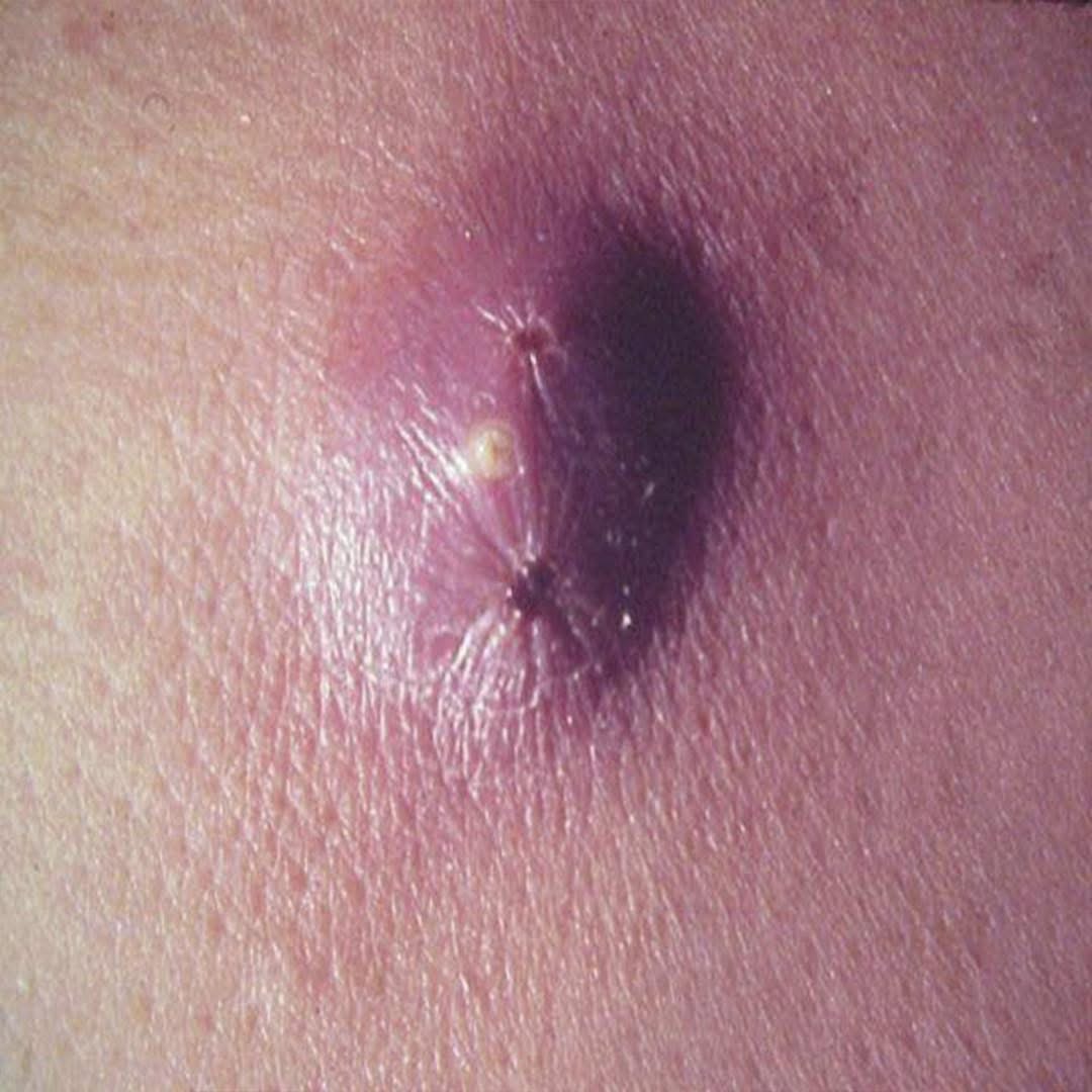 Tengan cuidado con el furuculos