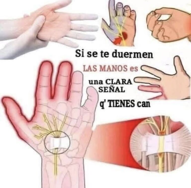 Cuando se te duerme la mano es una clara señal que tienes cáncer