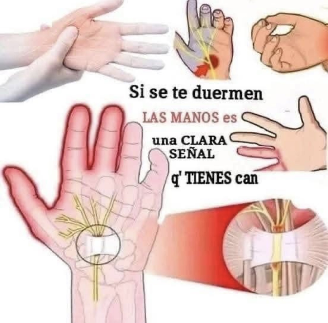 Cuando se te duerme la mano es una clara señal que tienes cáncer