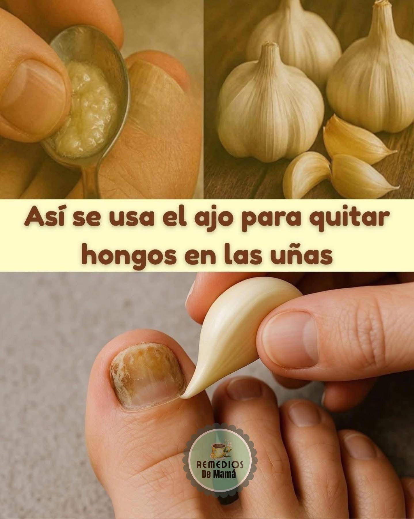 Así se usa el ajo para quitar hongos en las uñas (Funciona muy rápido)