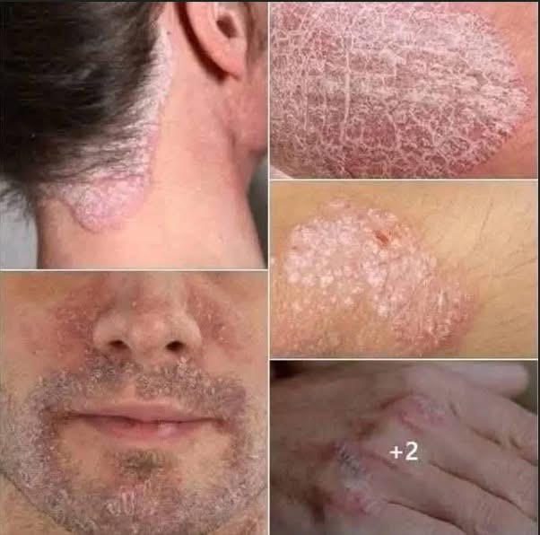 Señales de que podrías tener psoriasis: cómo identificarla, cuándo ver al médico y opciones de tratamiento