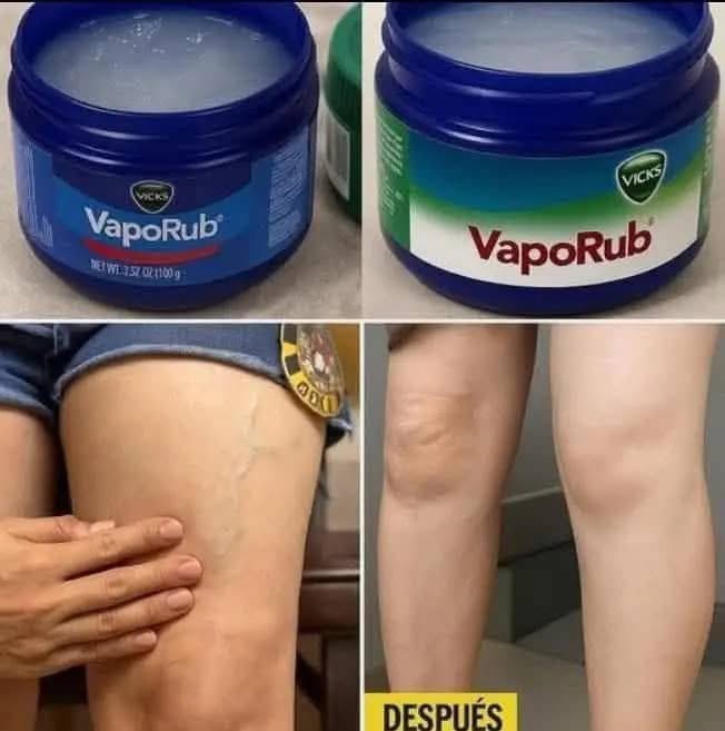 Este en el remedio más eficaz contrae la varices