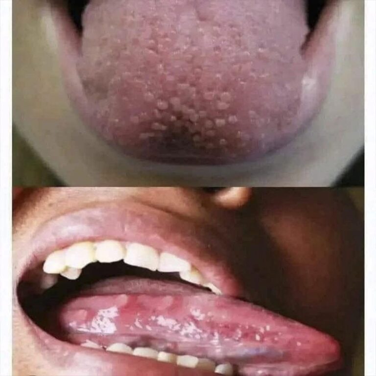 Si tienes estas bolitas en la lengua, preocúpate, es señal