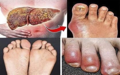 ¡El HÍGADO está muriendo! 12 señales de advertencia lo que tus pies te dicen sobre la salud de tu hígado img