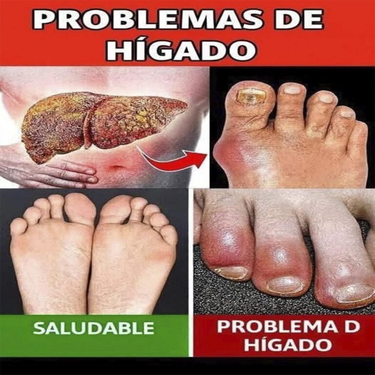 ¡El HÍGADO está muriendo! 12 señales de advertencia lo que tus pies te dicen sobre la salud de tu hígado
