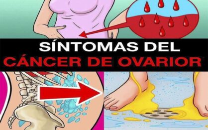 Descubre 7 señales silenciosas que podrían ser cáncer de ovario img