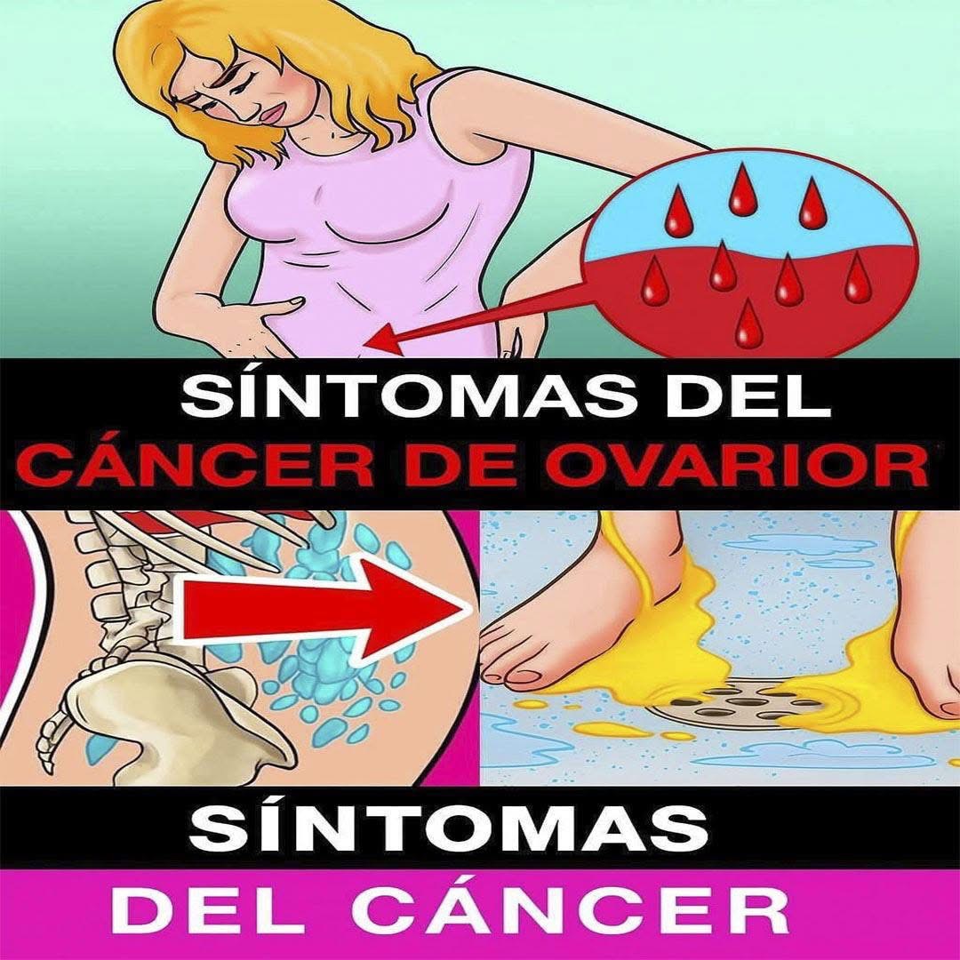 Descubre 7 señales silenciosas que podrían ser cáncer de ovario