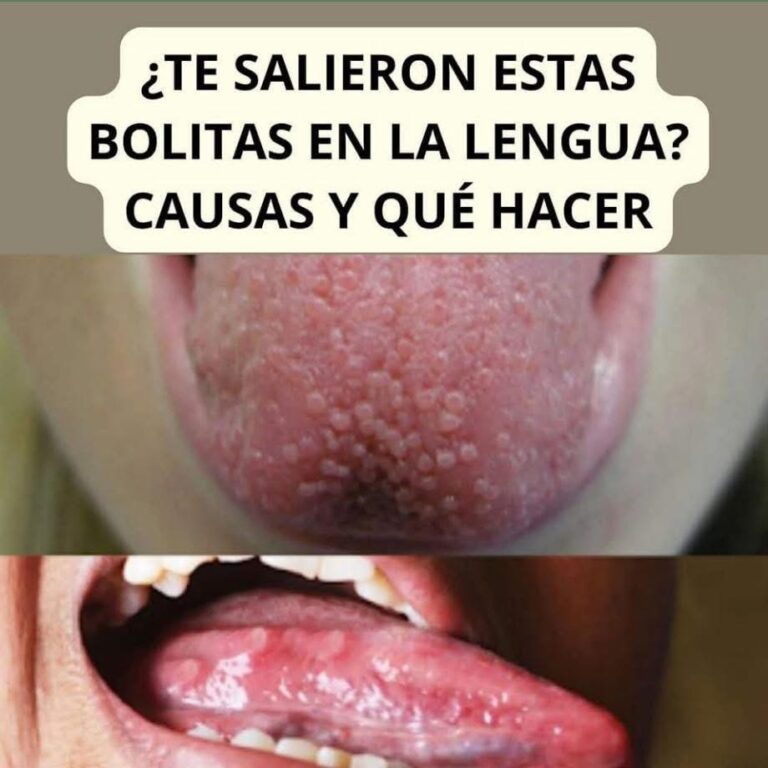¿Te salieron bolitas en la lengua? Aquí las causas y qué hacer