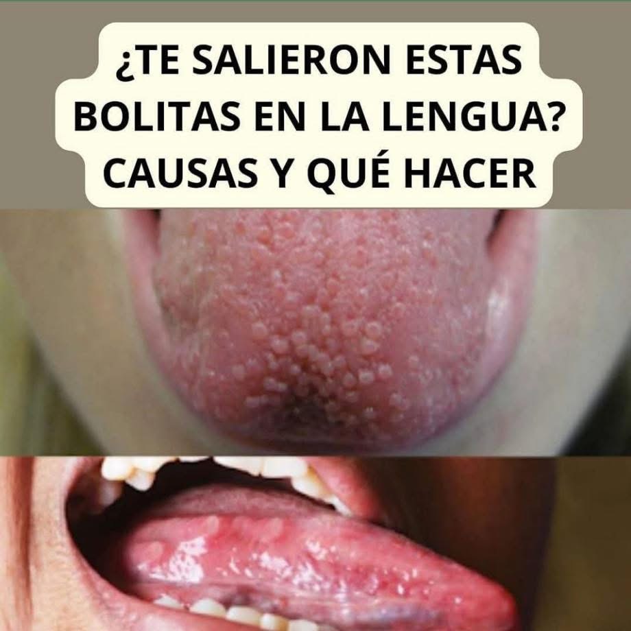 ¿Te salieron bolitas en la lengua? Aquí las causas y qué hacer