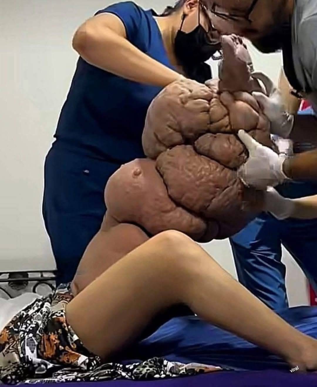 Cirugía impactante: extirpan un tumor gigante y salvan la vida de una paciente