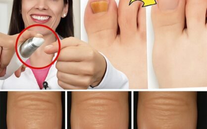 Nunca más tuve hongos ni micosis en las uñas después de usar esta receta img
