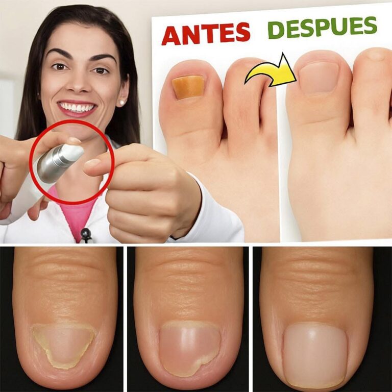 Nunca más tuve hongos ni micosis en las uñas después de usar esta receta