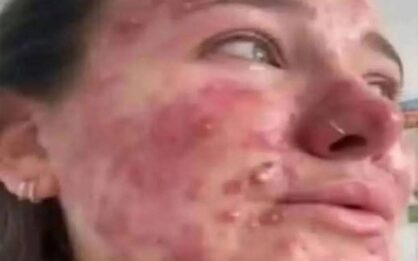 Señales de un cáncer en la sangre (Leucemia): síntomas que no debes pasar por alto img