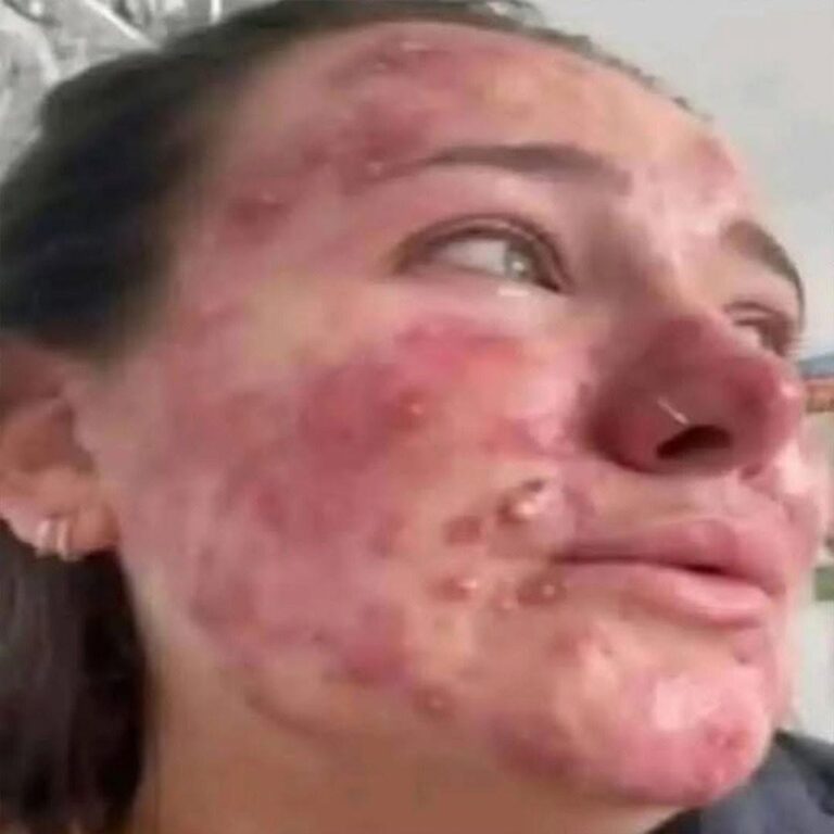 Señales de un cáncer en la sangre (Leucemia): síntomas que no debes pasar por alto