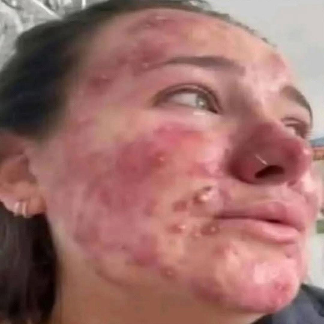 Señales de un cáncer en la sangre (Leucemia): síntomas que no debes pasar por alto