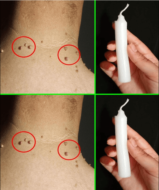 ¡Elimina las Verrugas de la Piel en Solo 3 Días – Con Solo una Vela!