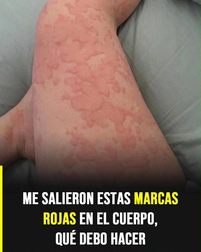 Nadie te advierte sobre estas manchas rojas: podrían ser una alergia peligrosa