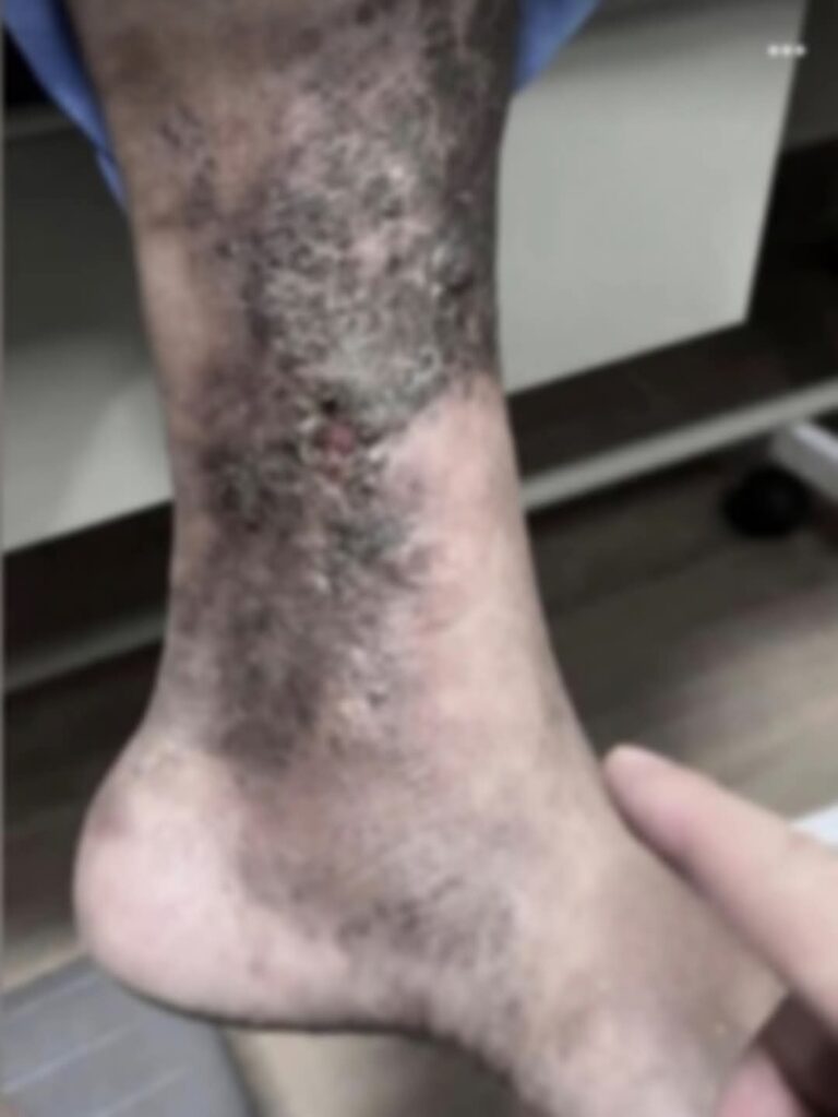 Manchas oscuras en los tobillos: la señal silenciosa que podrías estar ignorando