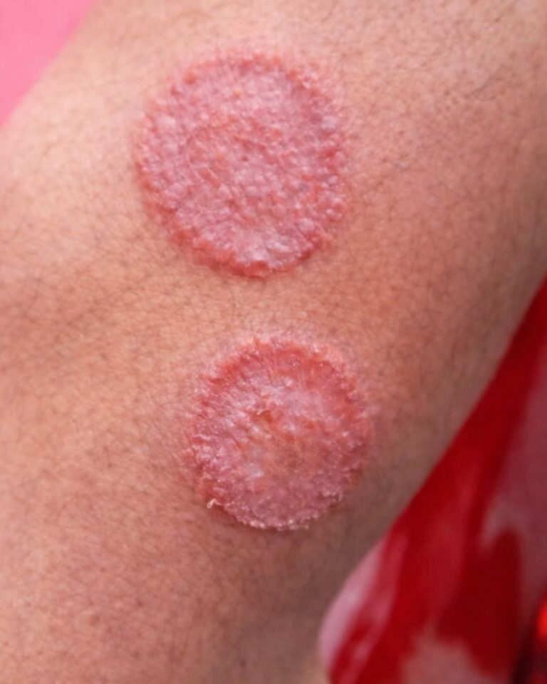 Estas manchas en la piel podrían estar alertando algo importante… no las ignores