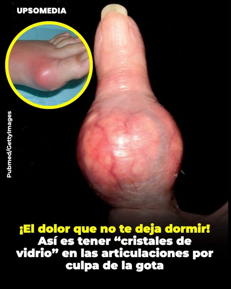 Gota: el dolor que despierta en la madrugada y convierte un dedo del pie en una tortura