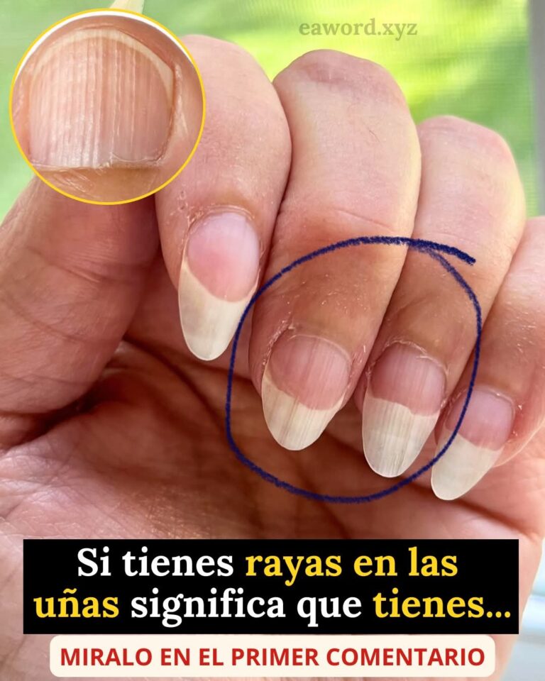 Si tienes rayas en las uñas… no siempre es lo que crees (esto es lo que realmente significan)