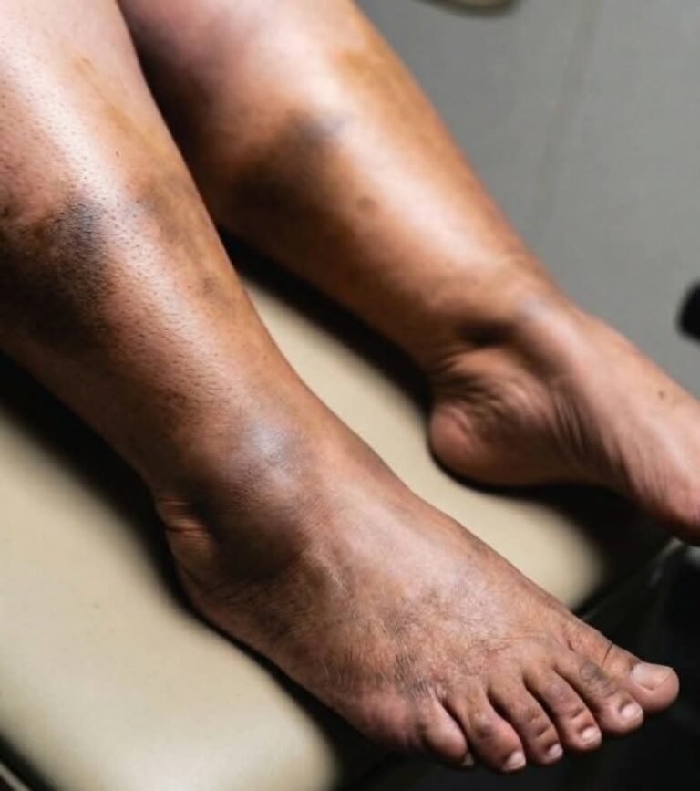 ⚠️ Manchas oscuras en los pies: lo que tu cuerpo podría estar intentando decirte