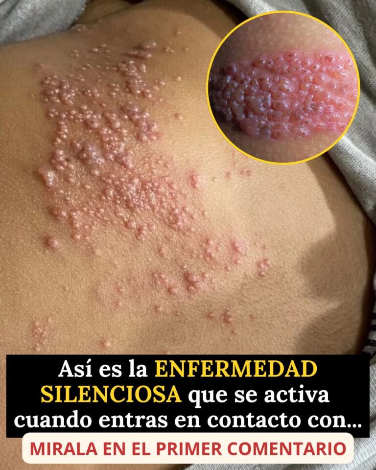 Así es la erupción dolorosa que muchas personas confunden… y puede aparecer cuando tus defensas bajan
