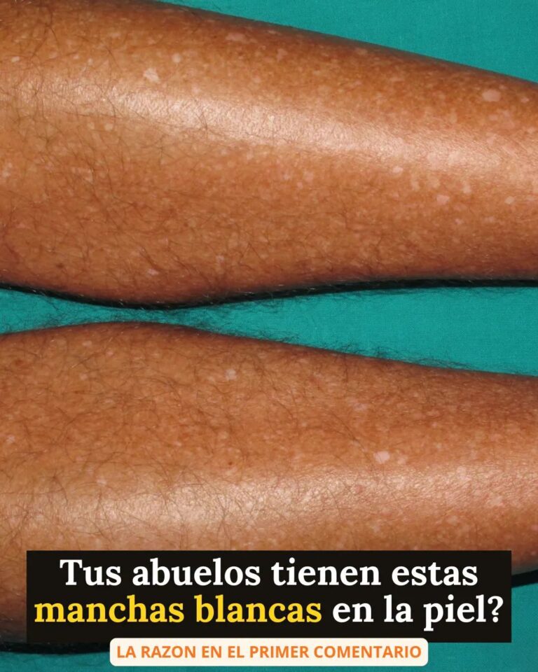 ⚠️ Si tus abuelitos tienen estas manchitas en la piel… presta atención