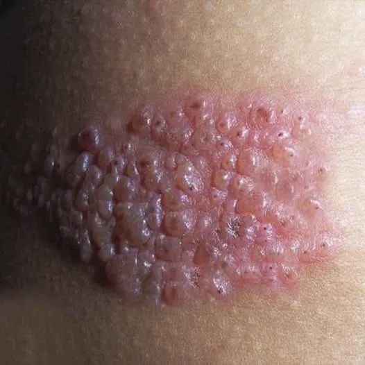 ⚠️ Así es el herpes zóster: la enfermedad silenciosa que puede aparecer cuando menos lo esperas