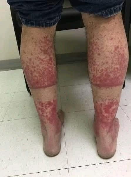 ⚠️ Marcas rojas en las piernas al despertar: esto es lo que podría estar pasando