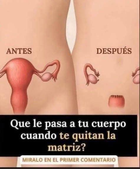 😳 ¿Qué pasa realmente cuando te quitan la matriz?