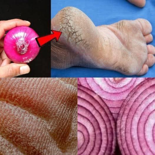 👣 Talones agrietados: lo que realmente ayuda a suavizarlos y qué errores debes evitar